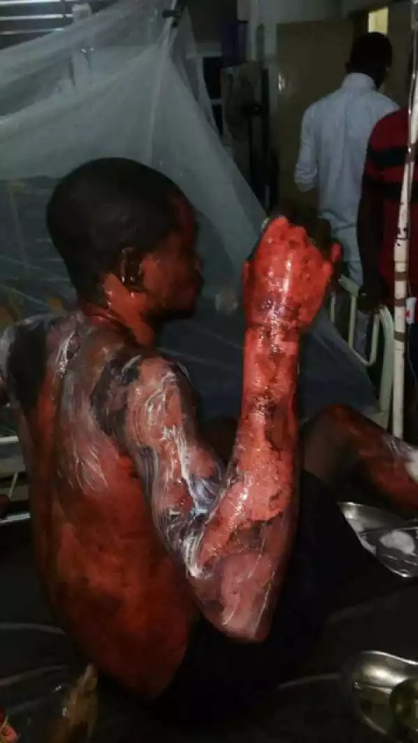 Tragic: Jilted Lover Bathes Husband with Hot Water for Marrying Another Wife (Graphic Photos)